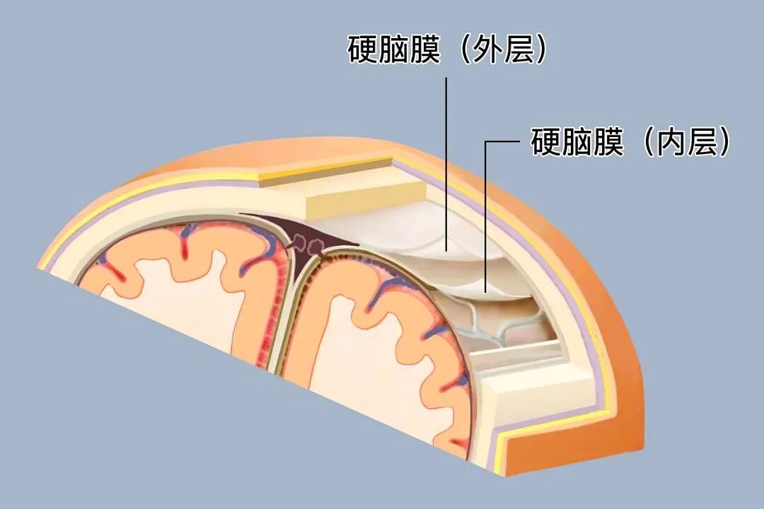 新西兰首例！婴儿植入死者脑膜，43年后疾病爆发，人生被摧毁了（组图） - 2