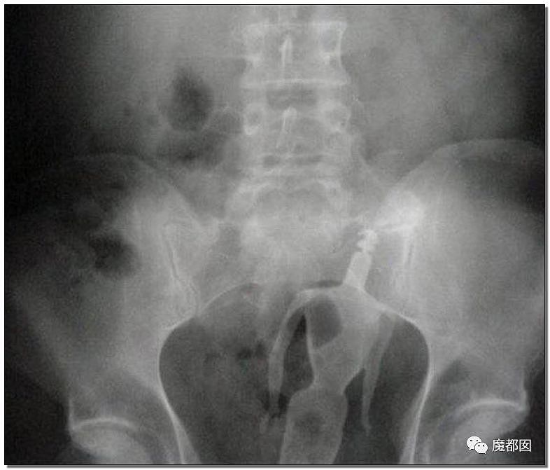 14岁男孩网购假YJ塞GM后整体滑入拿不出来!青少年X教育热议 - 122