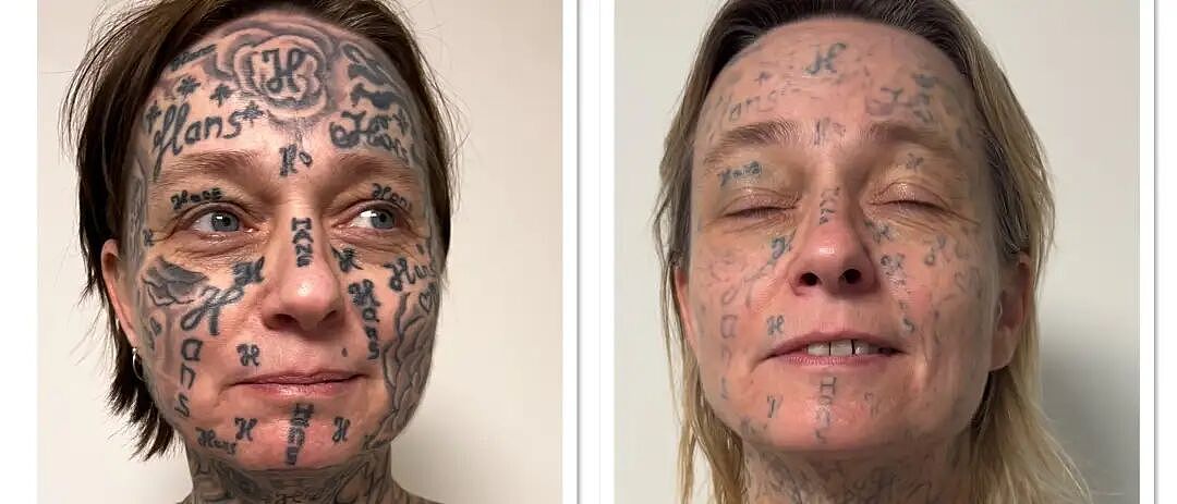 被迫纹身250次,90%皮肤成前任的“签名”,现在她只想洗白自己(组图) - 1