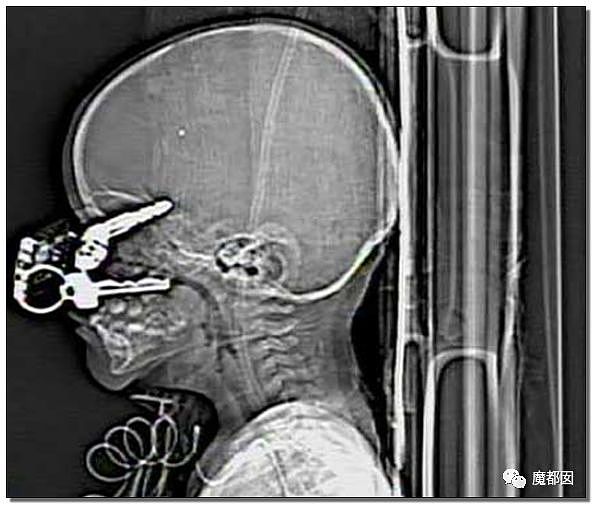 14岁男孩网购假YJ塞GM后整体滑入拿不出来!青少年X教育热议 - 79
