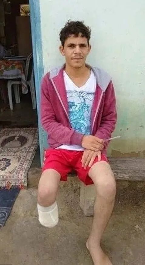 狠人！为骗200万保险金砍断自己右脚，因为一个原因被一眼识破… 血亏（组图） - 2