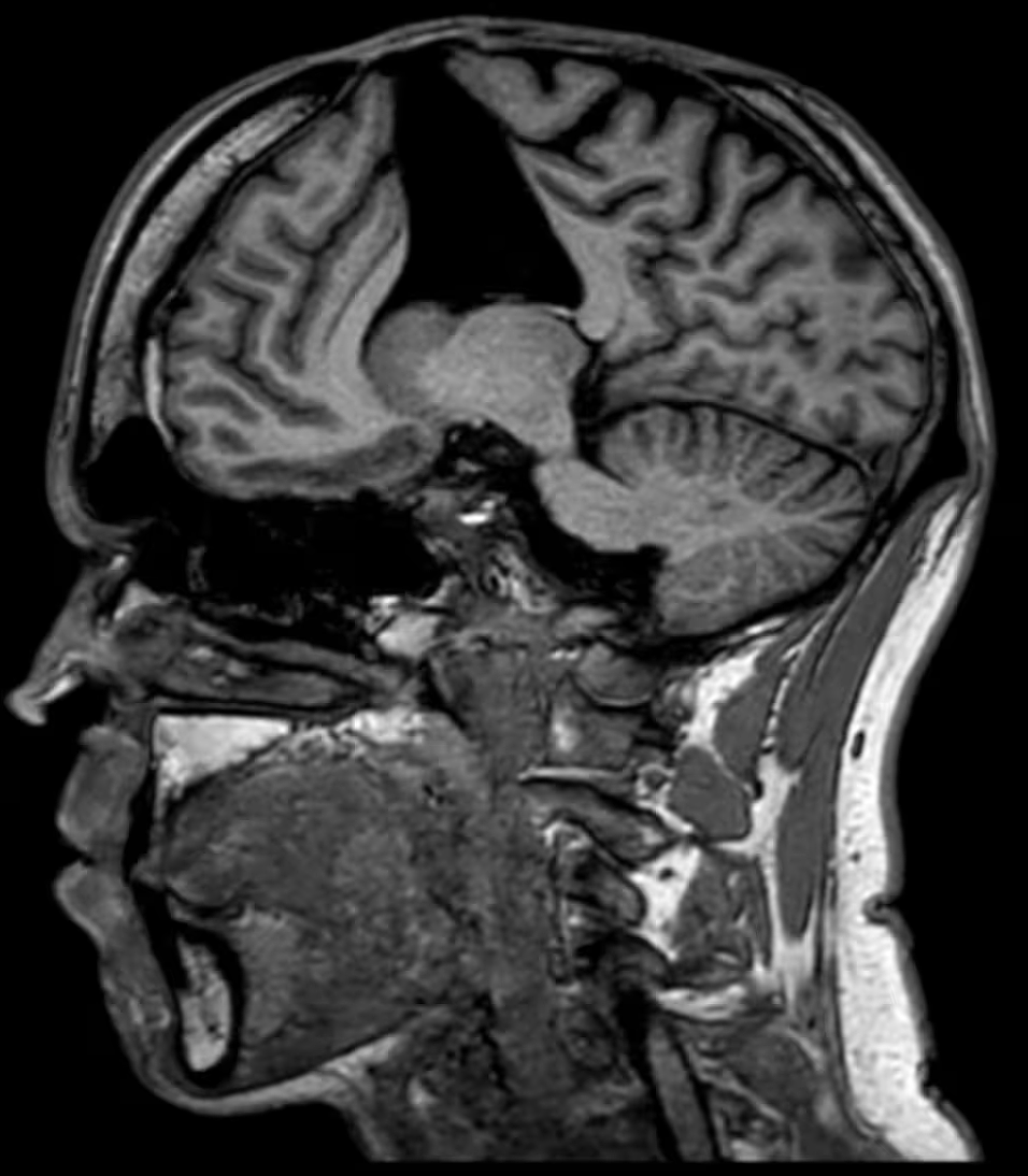 新西兰首例！婴儿植入死者脑膜，43年后疾病爆发，人生被摧毁了（组图） - 3
